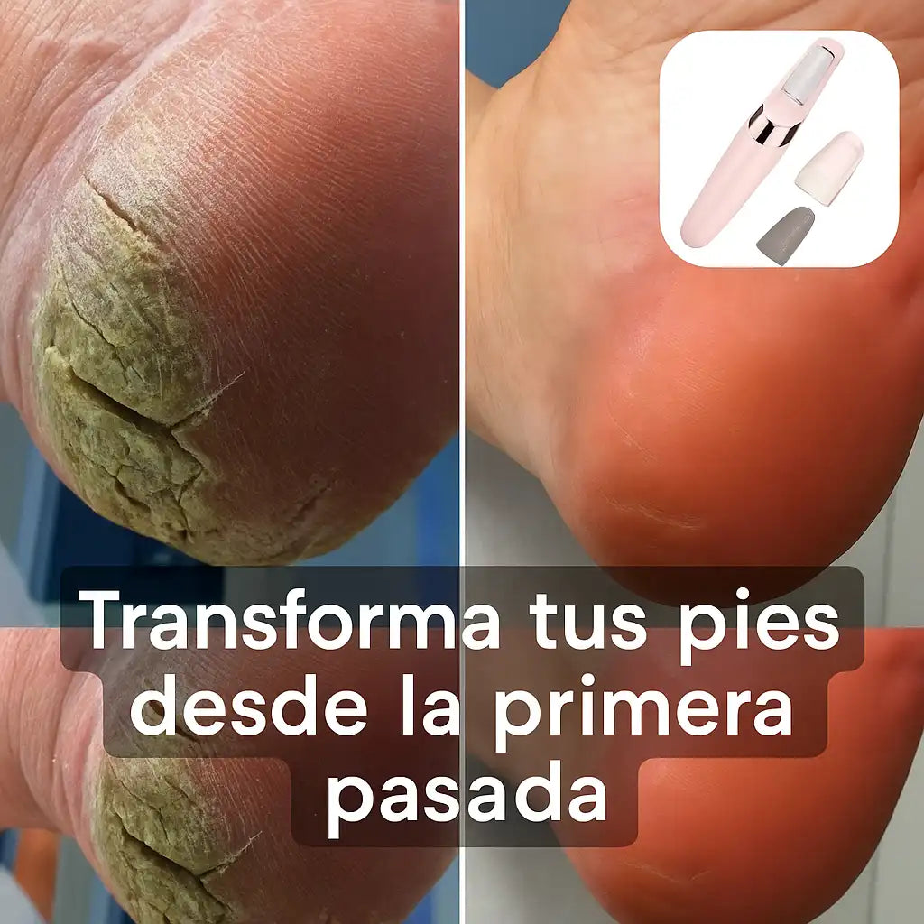SoftFeet™ – Removedor de Callos Portátil | Pies Suaves al Instante, Sin Dolor