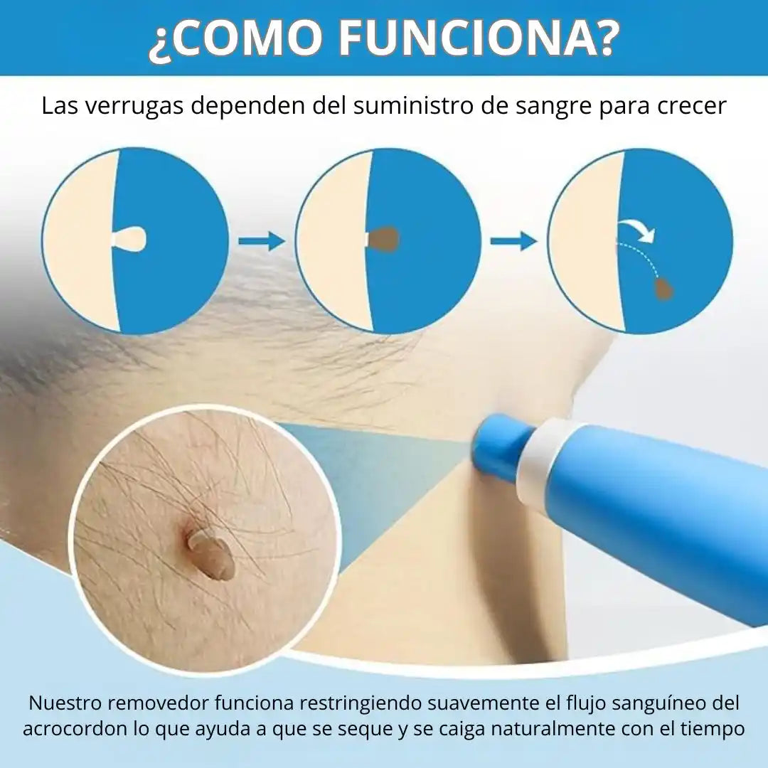 TagBuddy® – Kit Removedor de Verrugas | precisa y sin molestias