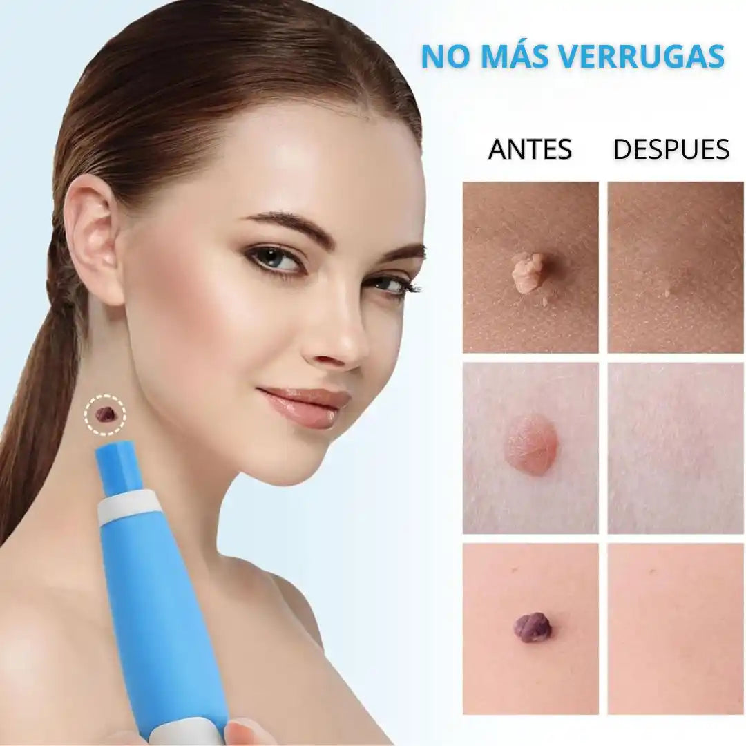 TagBuddy® – Kit Removedor de Verrugas | precisa y sin molestias