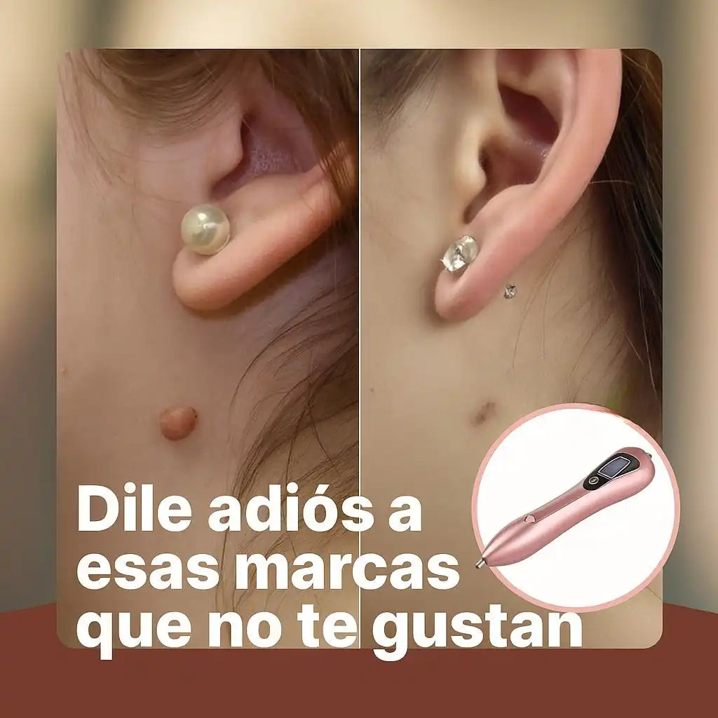 SkinZap® | Removedor Estético de Manchas, Verrugas y Lunares